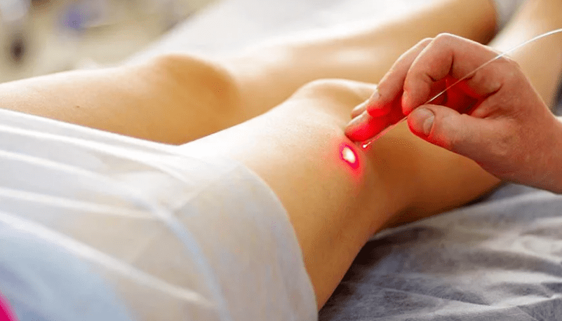 Coagularea laser a varicelor