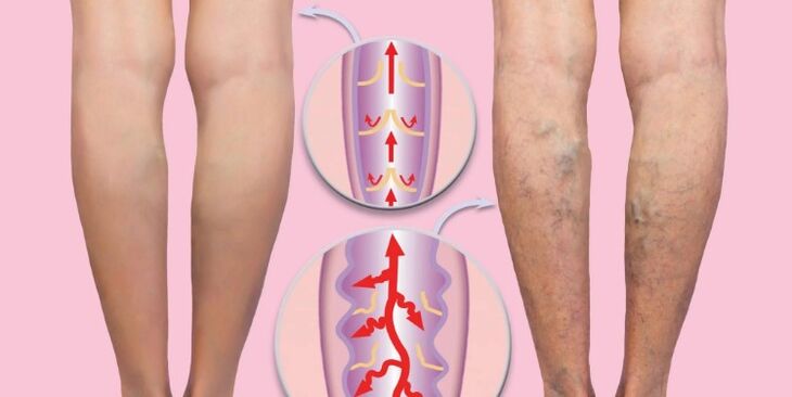 vene varicoase sănătoase pe picior